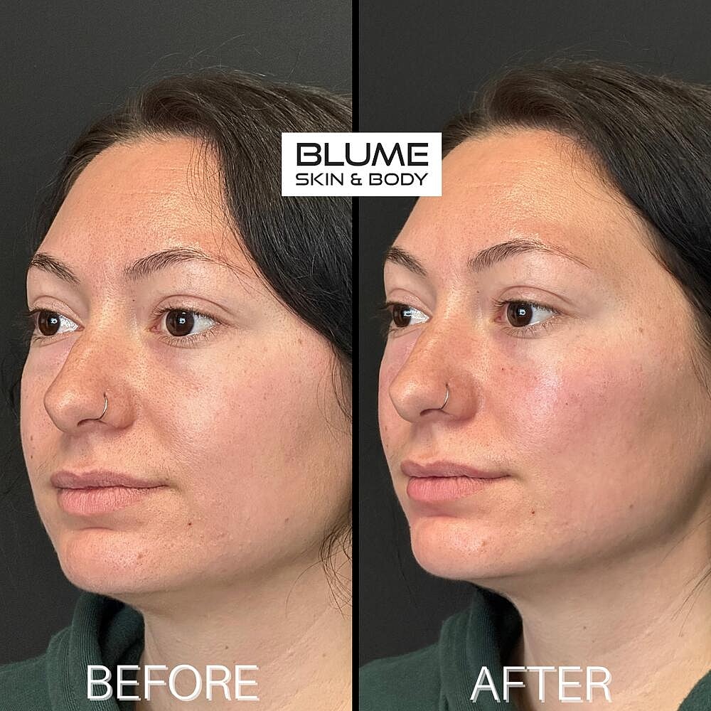 Dermal Fillers Before & After