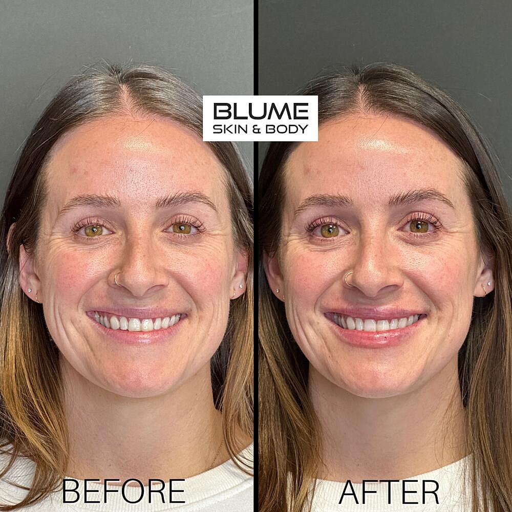 Dermal Fillers Before & After