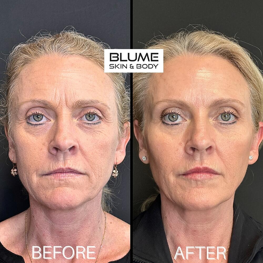 Dermal Fillers Before & After