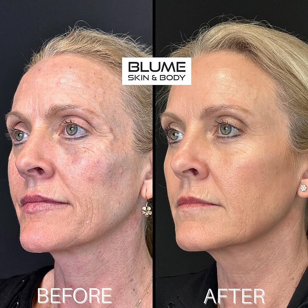 Dermal Fillers Before & After