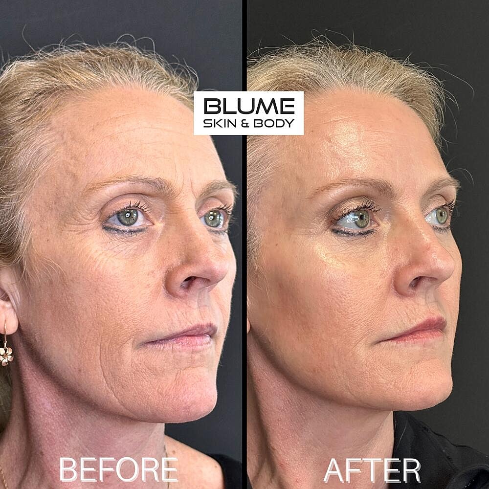 Dermal Fillers Before & After