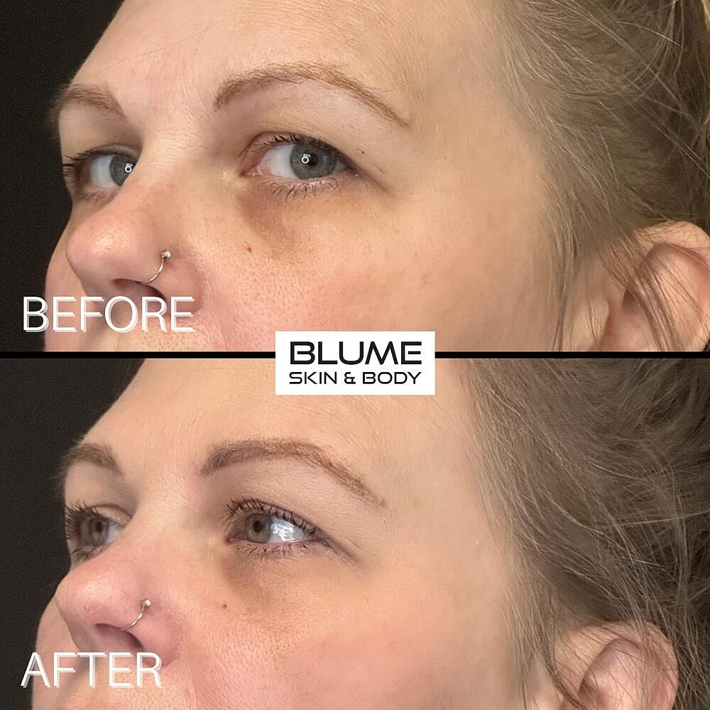 Dermal Fillers Before & After