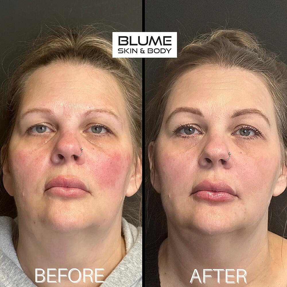 Dermal Fillers Before & After