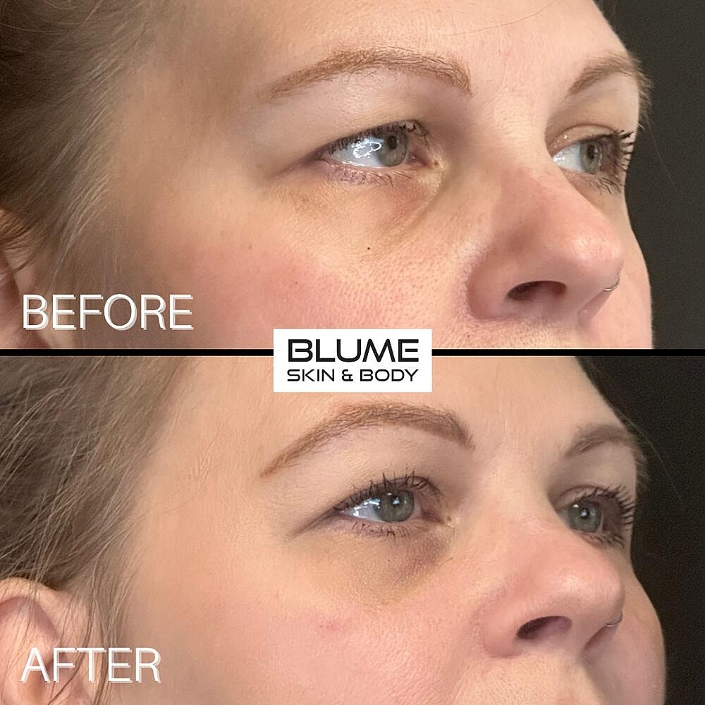 Dermal Fillers Before & After