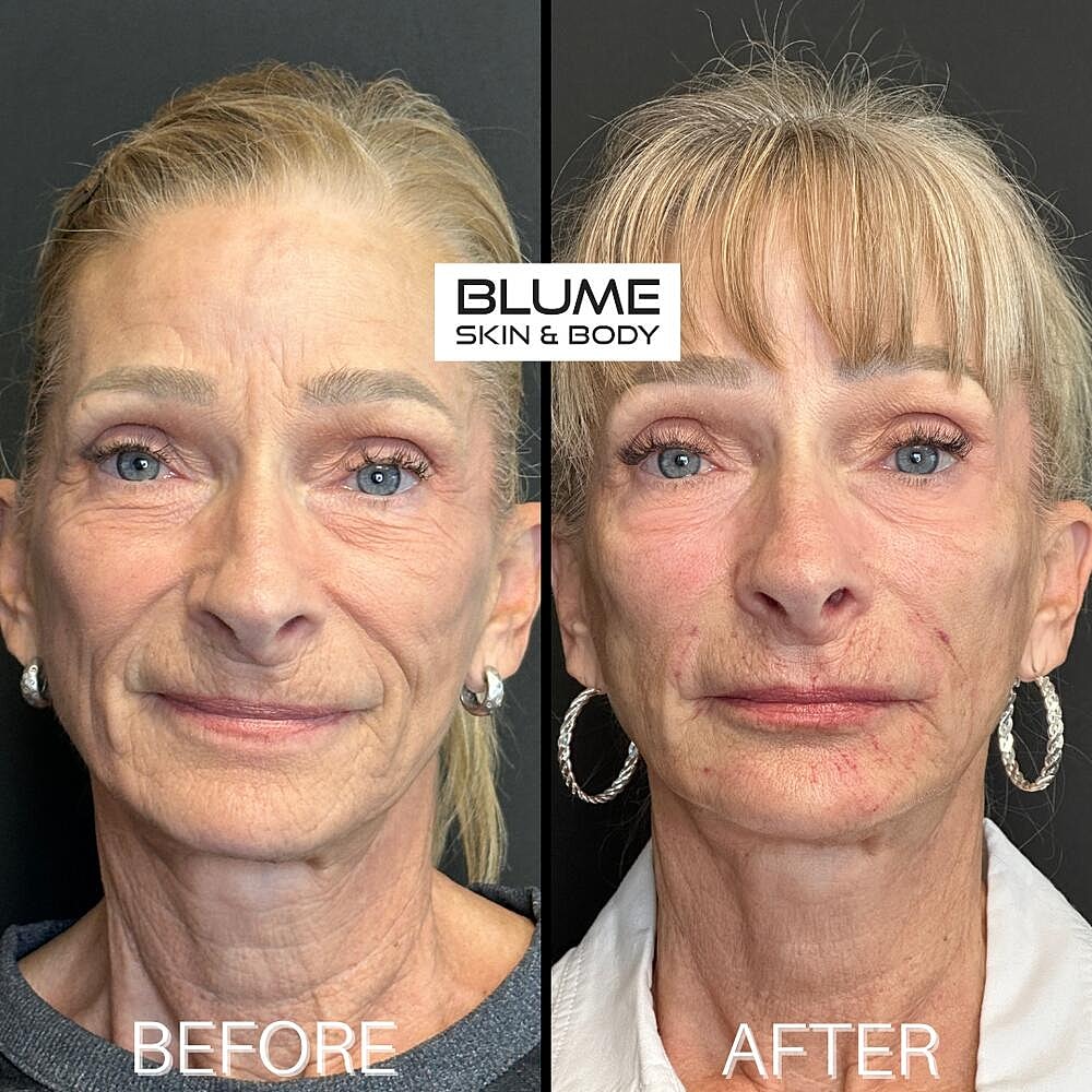 Dermal Fillers Before & After