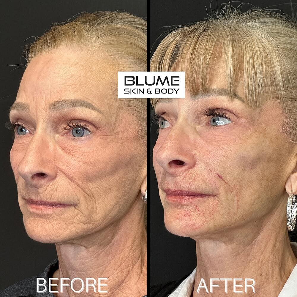 Dermal Fillers Before & After