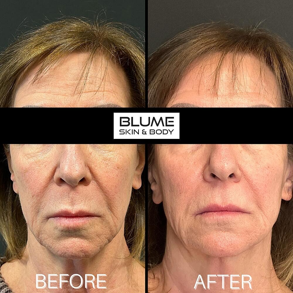 Dermal Fillers Before & After