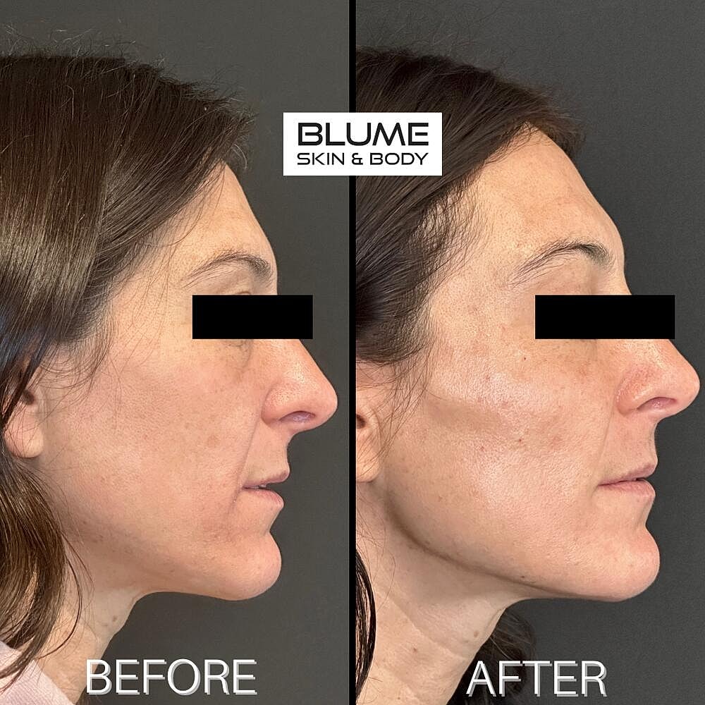 Dermal Fillers Before & After