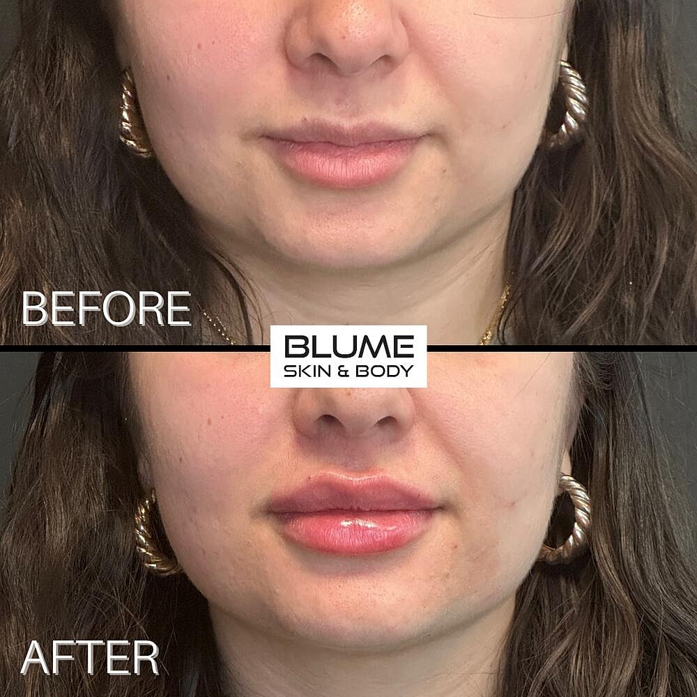 Dermal Fillers Before & After