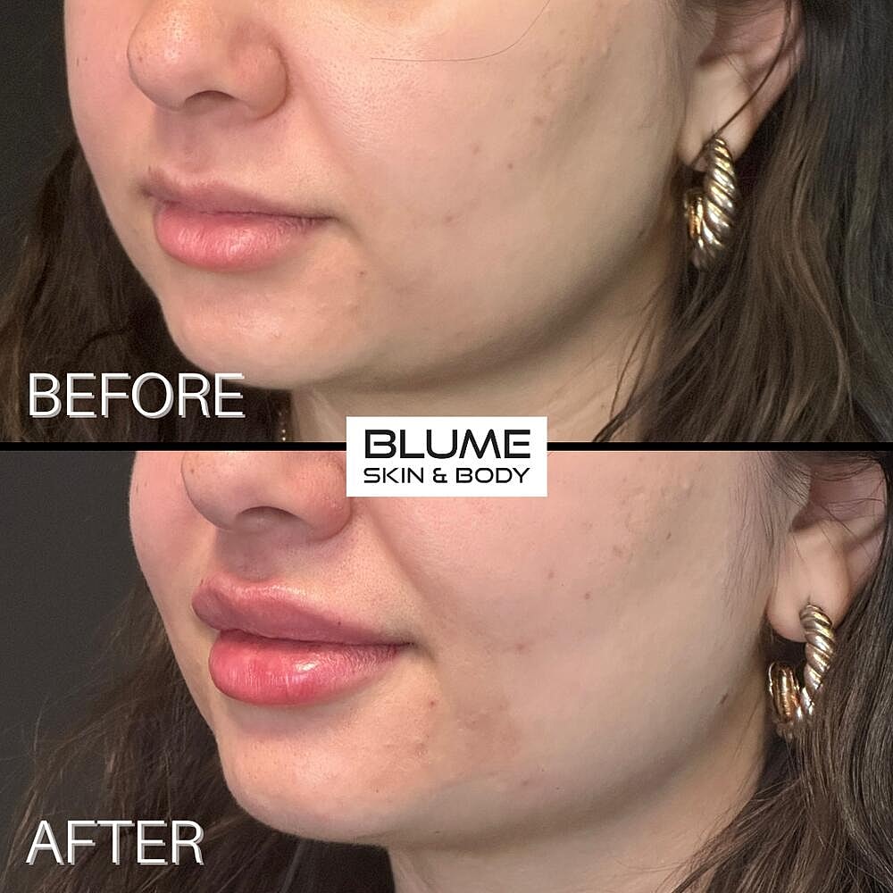Dermal Fillers Before & After