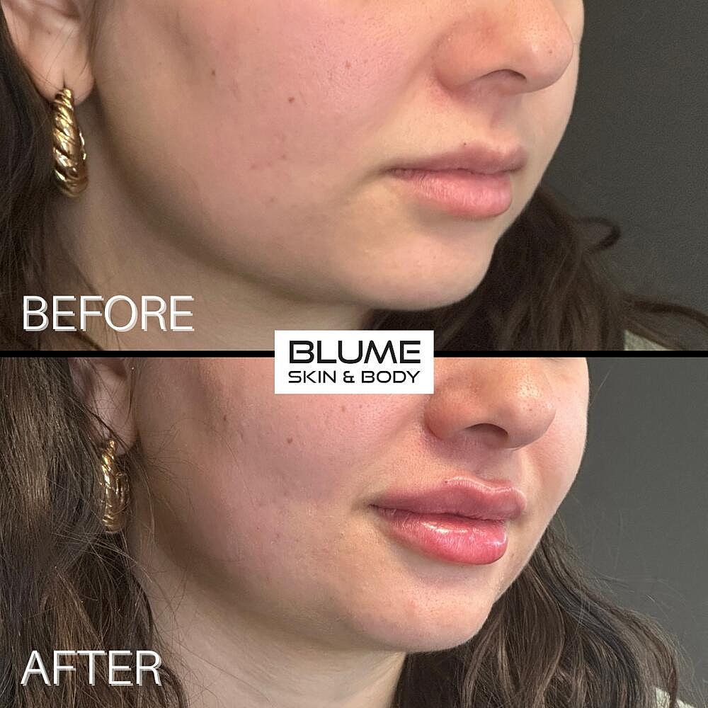 Dermal Fillers Before & After