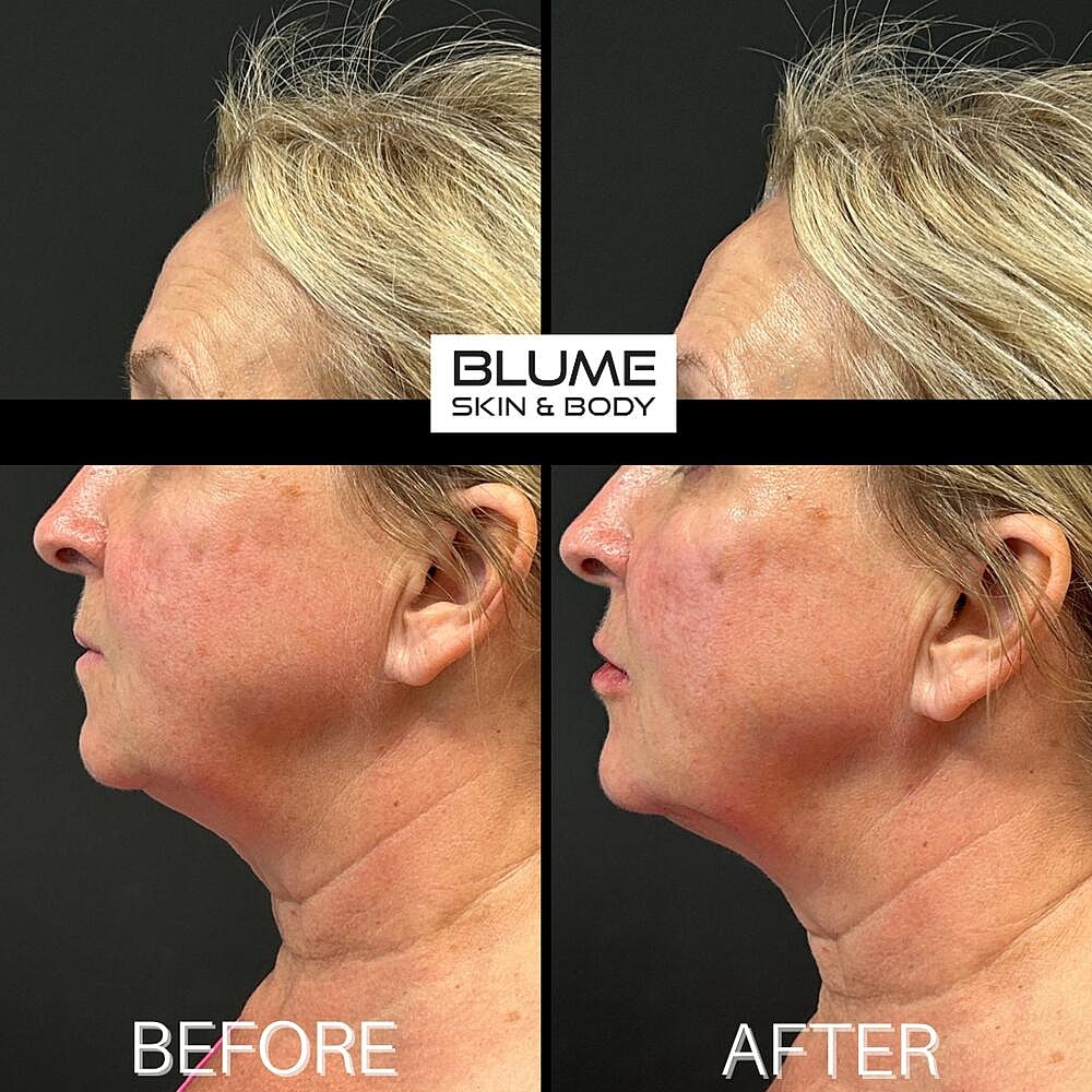 Dermal Fillers Before & After