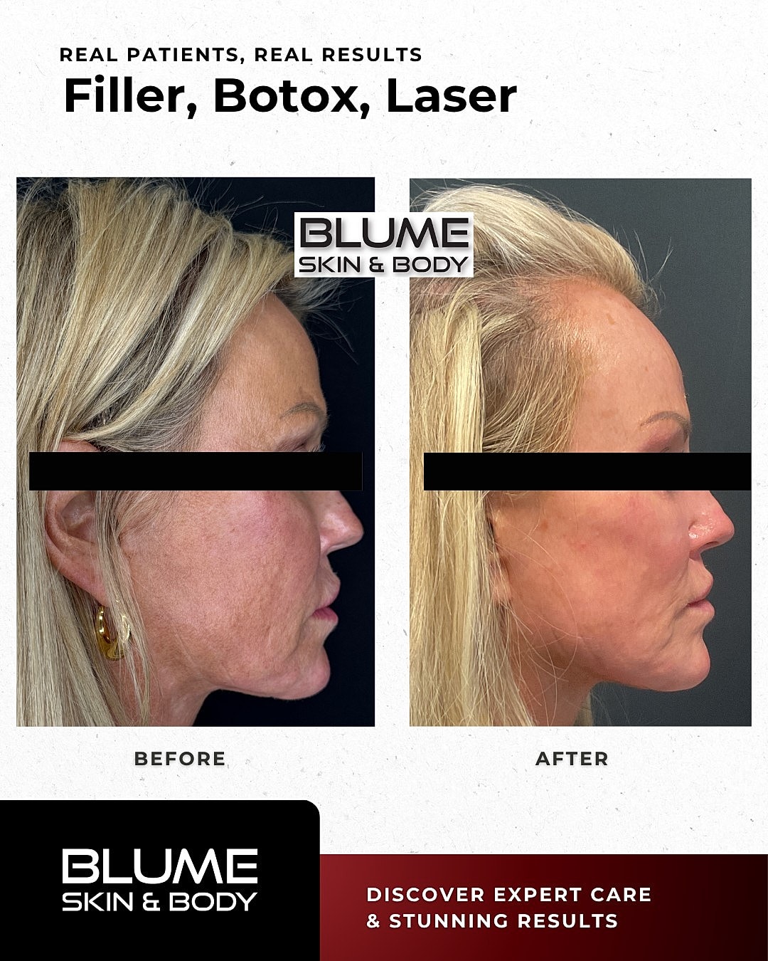 Before and after results of facial treatments