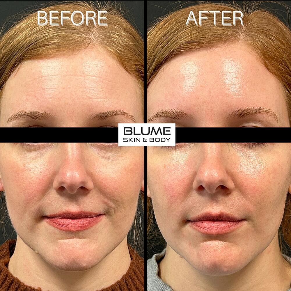 Dermal Fillers Before & After