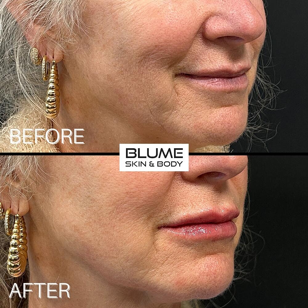 Dermal Fillers Before & After