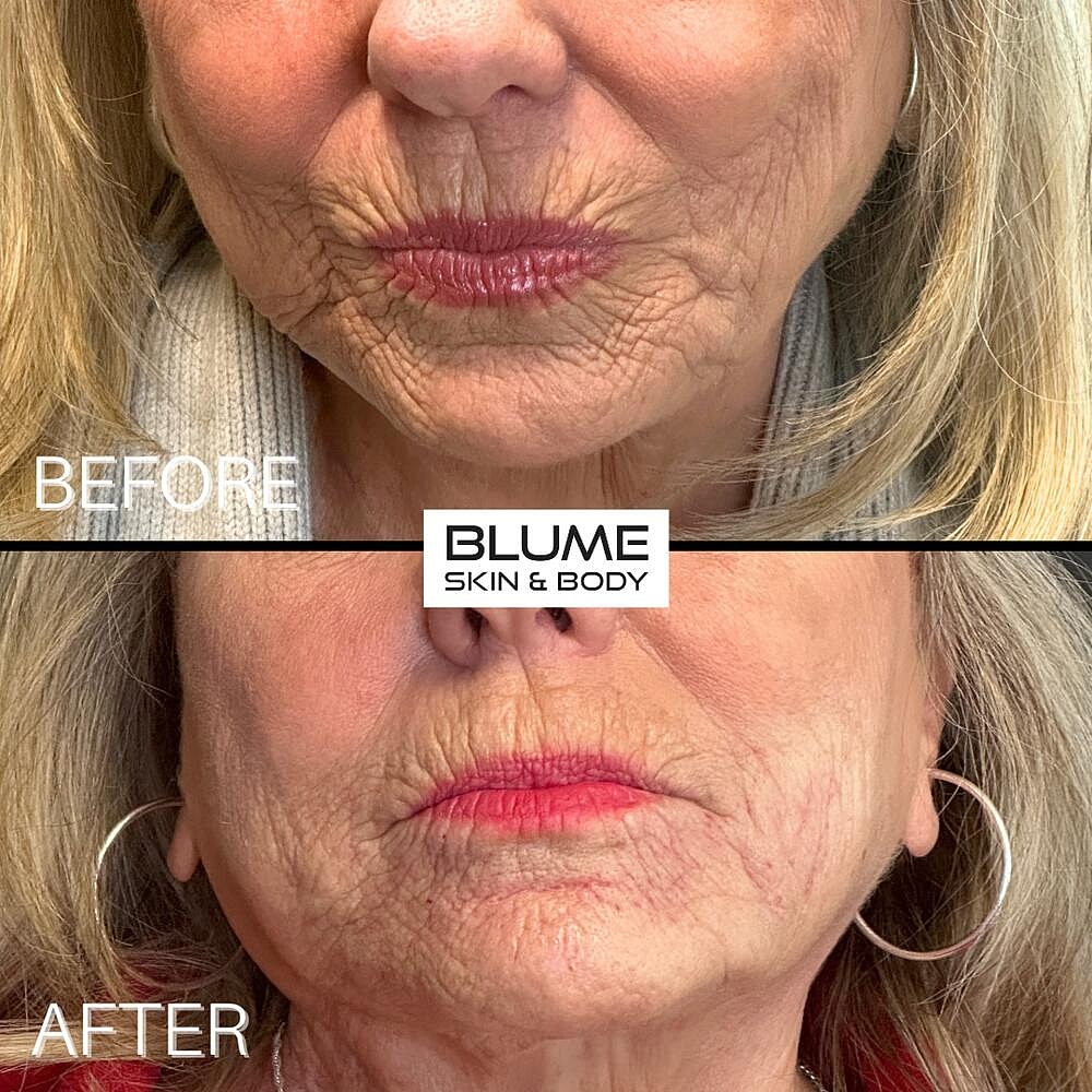 Dermal Fillers Before & After