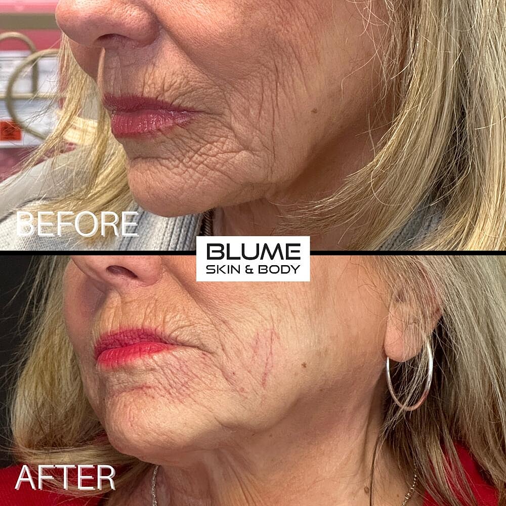 Dermal Fillers Before & After