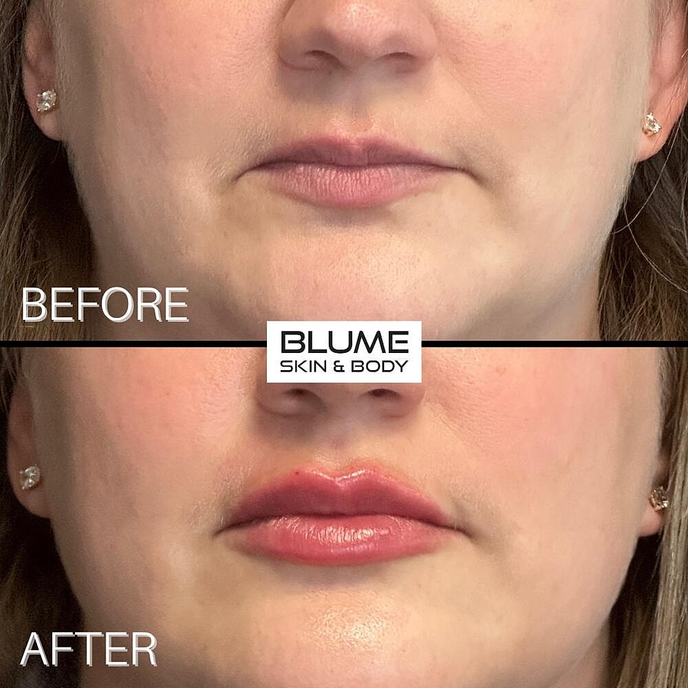 Dermal Fillers Before & After