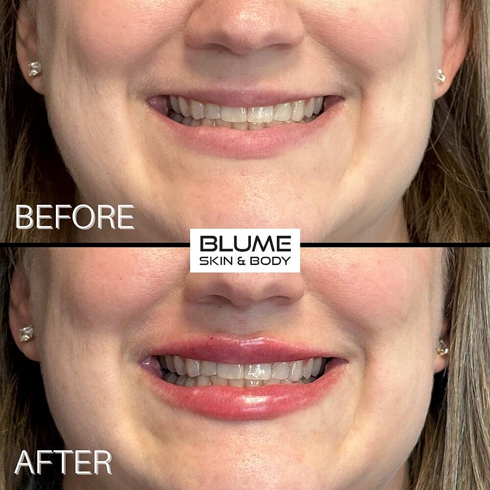 Dermal Fillers Before & After