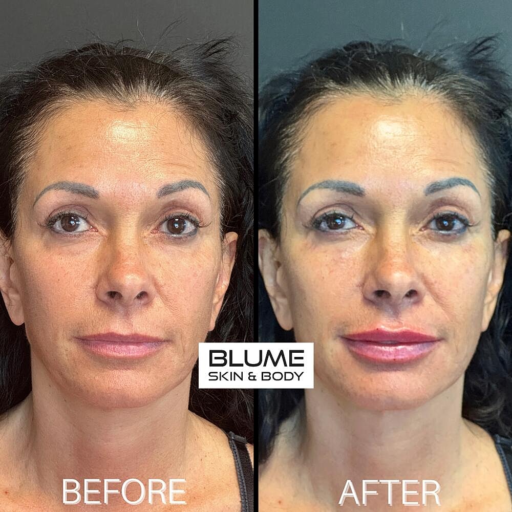 Dermal Fillers Before & After