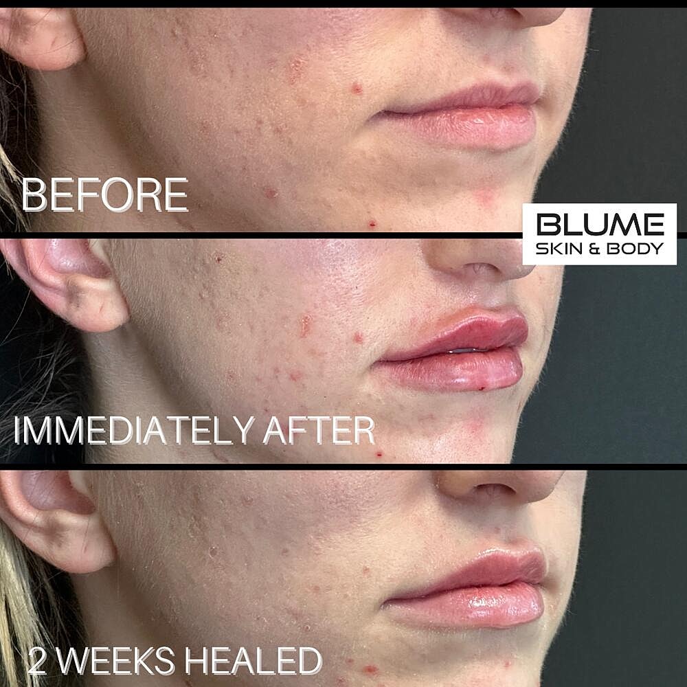 Dermal Fillers Before & After