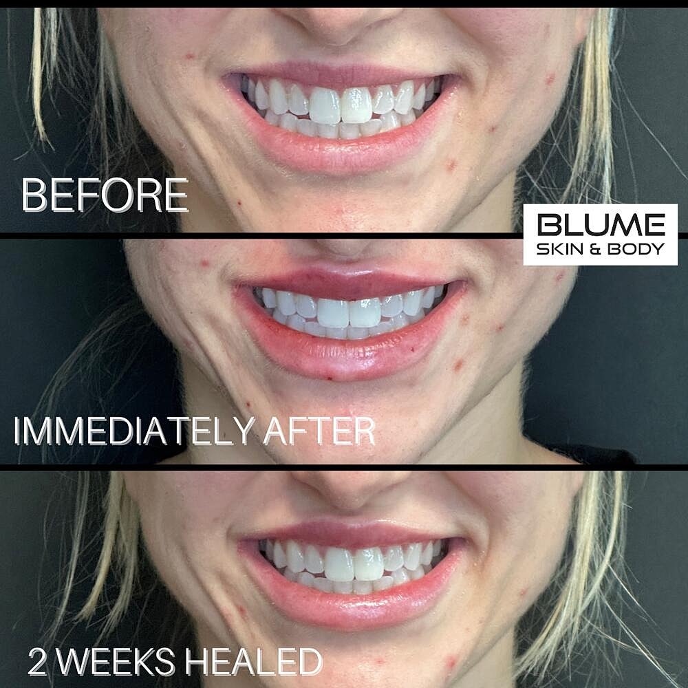 Dermal Fillers Before & After