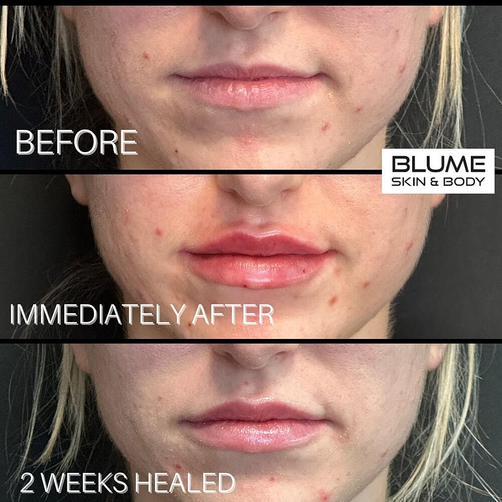 Dermal Fillers Before & After