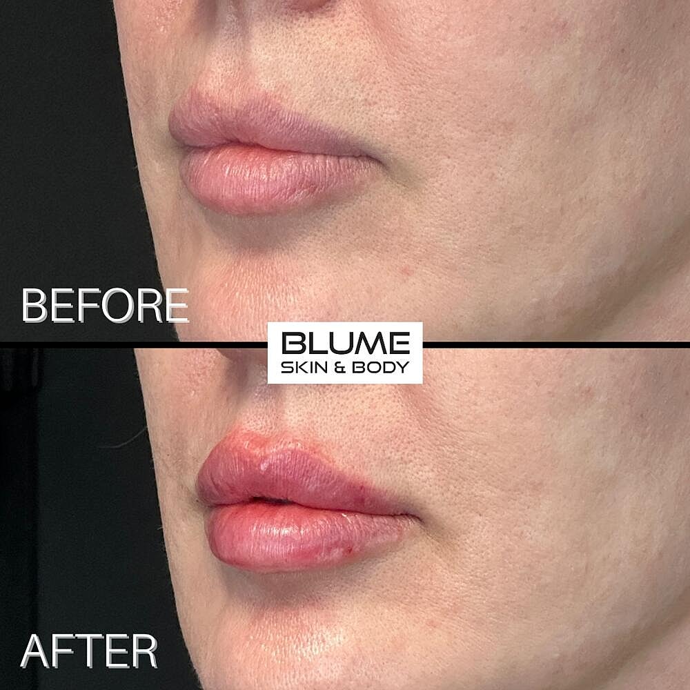 Dermal Fillers Before & After