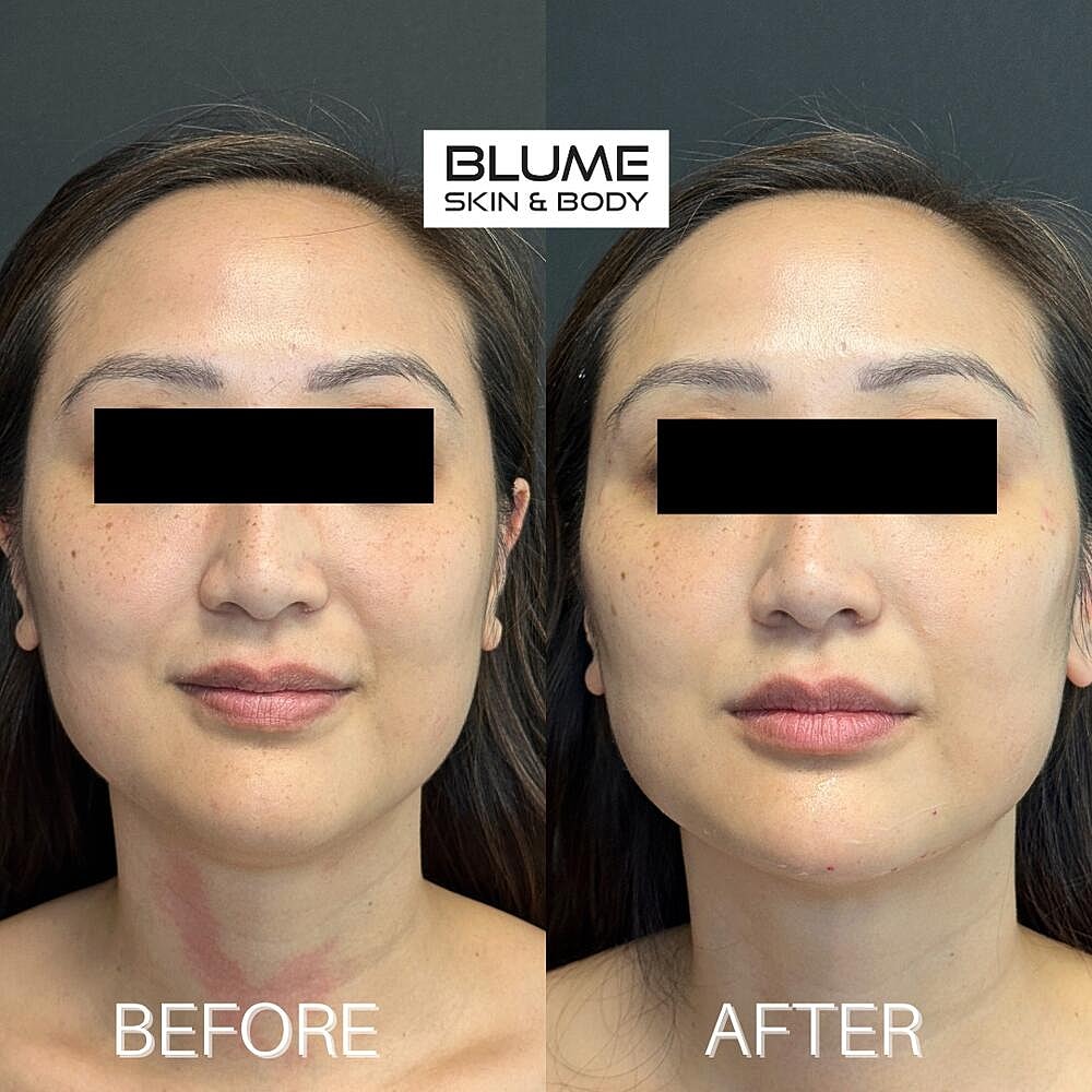 Dermal Fillers Before & After