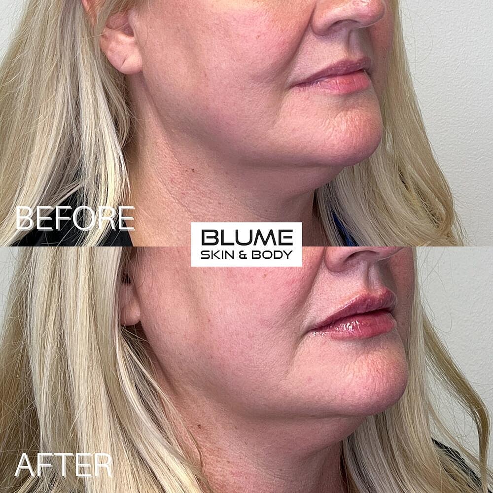 Dermal Fillers Before & After