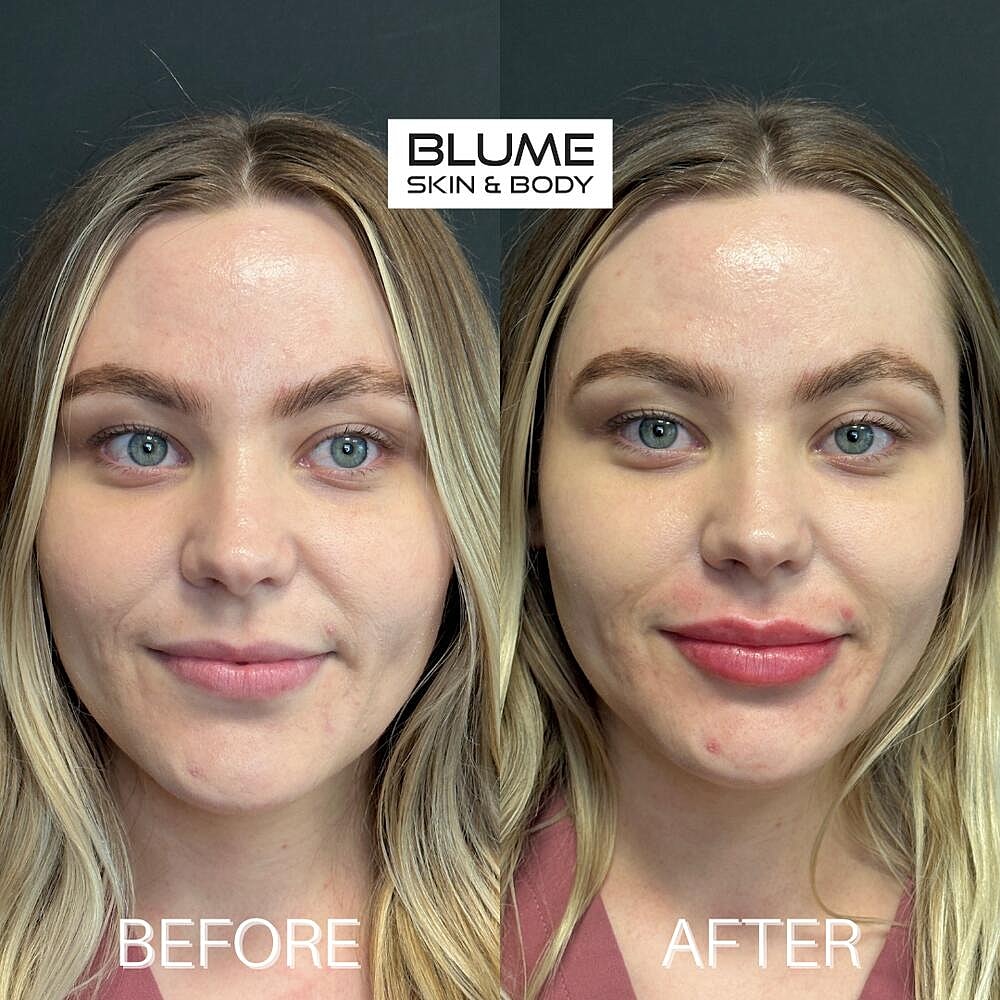 Dermal Fillers Before & After
