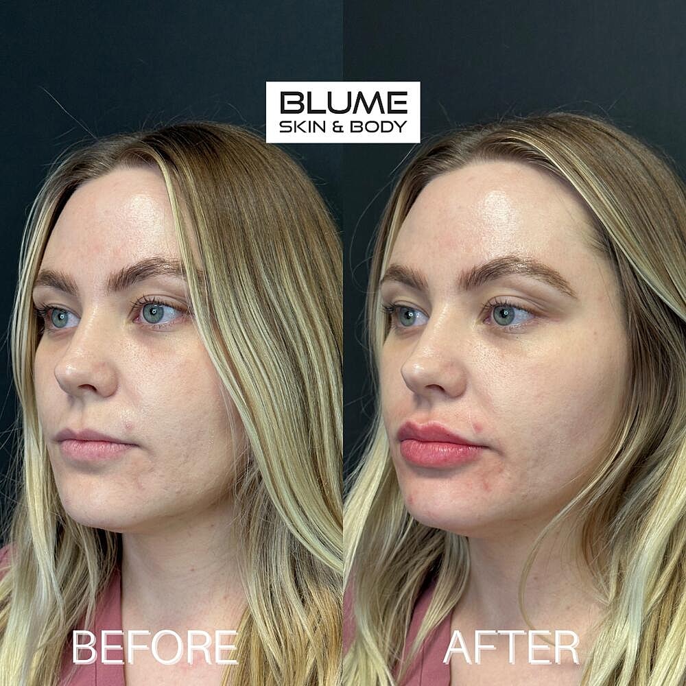 Dermal Fillers Before & After