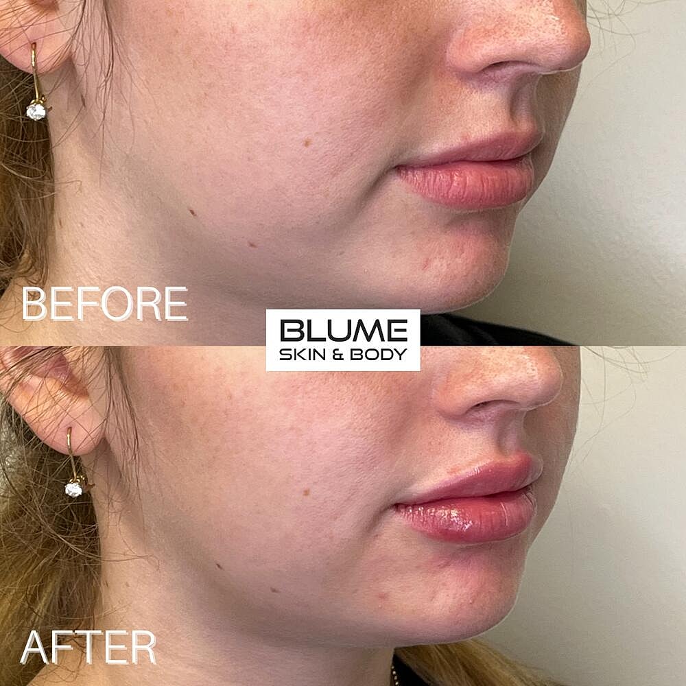 Dermal Fillers Before & After