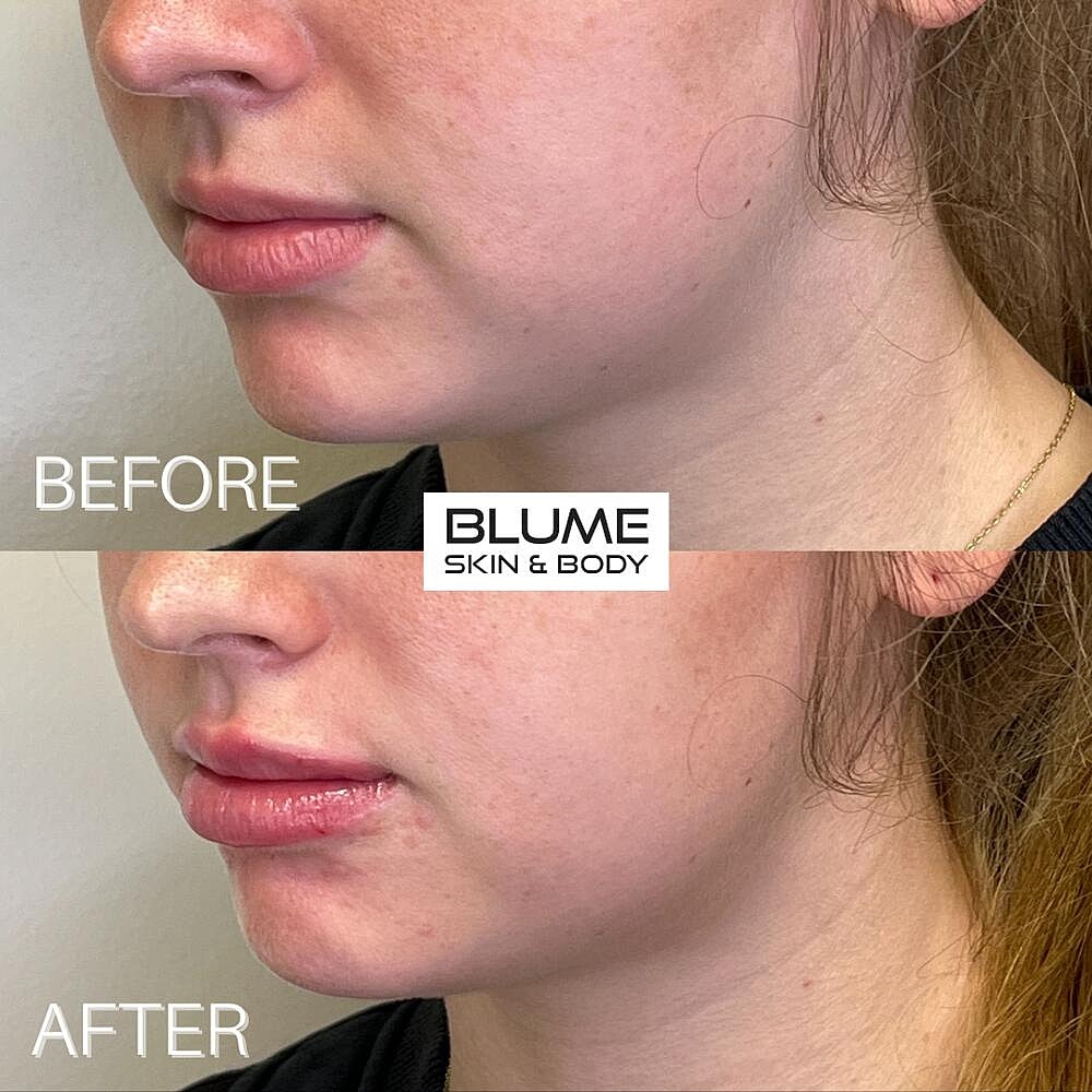 Dermal Fillers Before & After