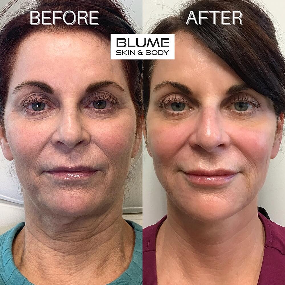 Dermal Fillers Before & After