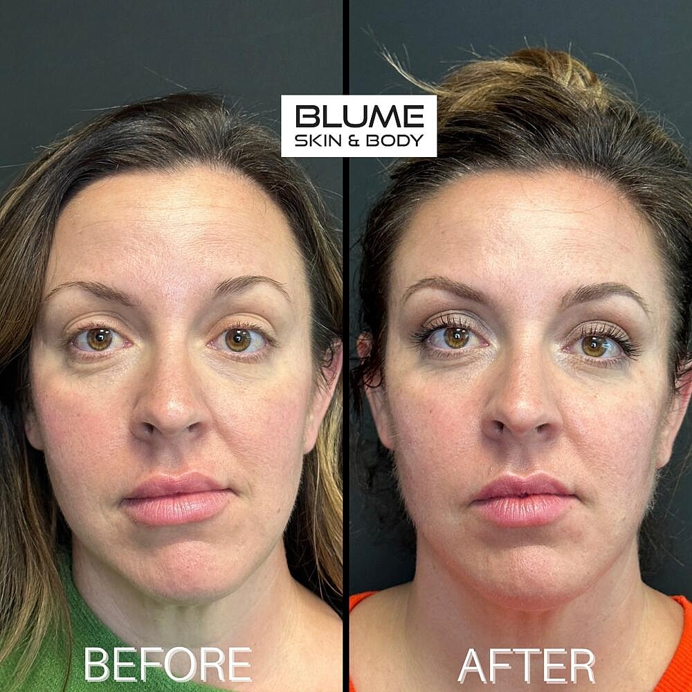Dermal Fillers Before & After