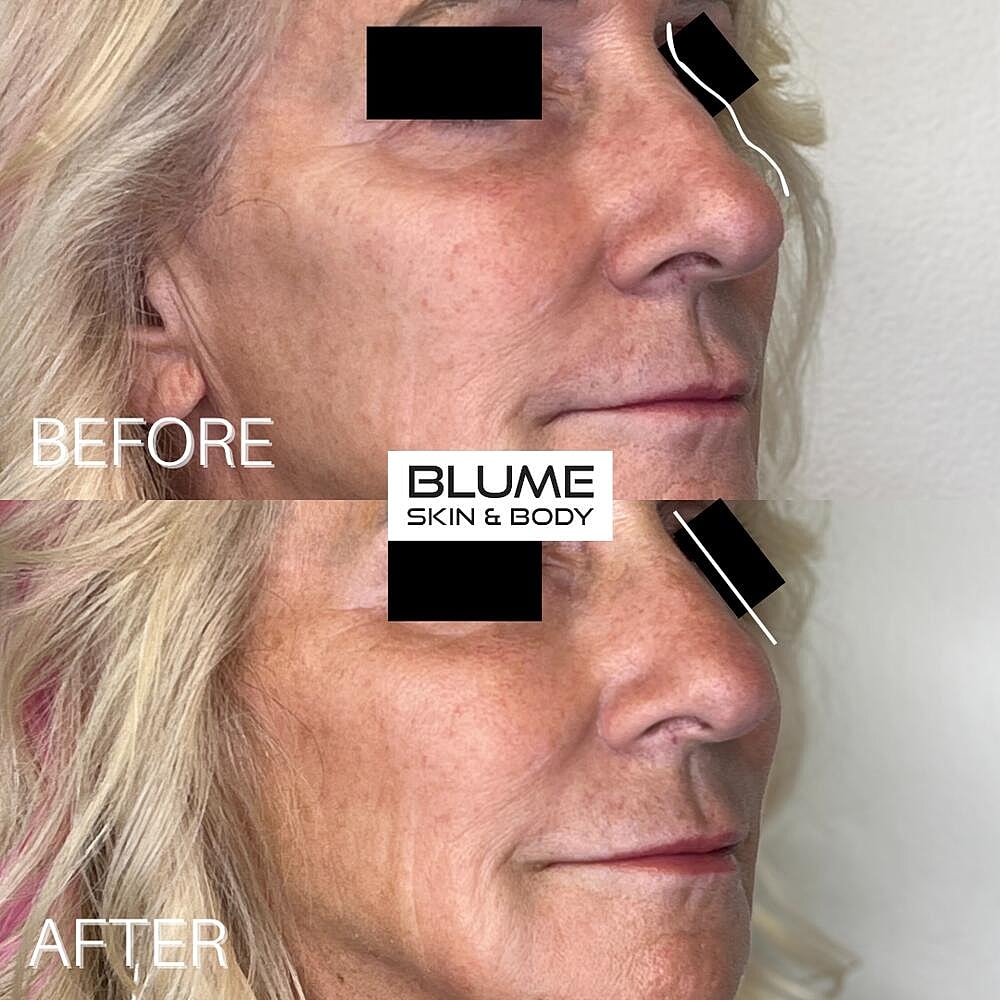 Dermal Fillers Before & After