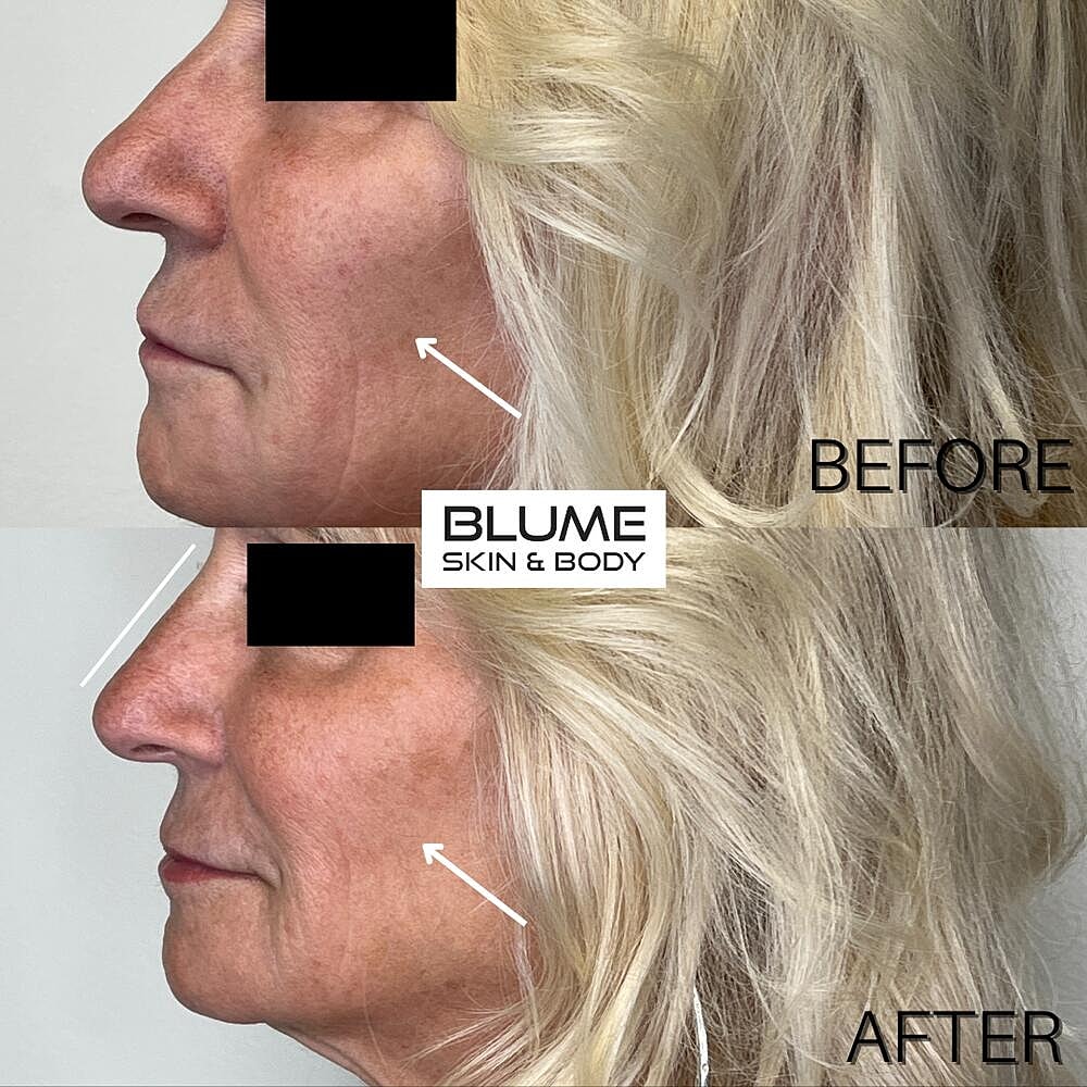 Dermal Fillers Before & After