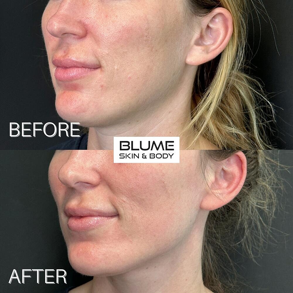 Dermal Fillers Before & After