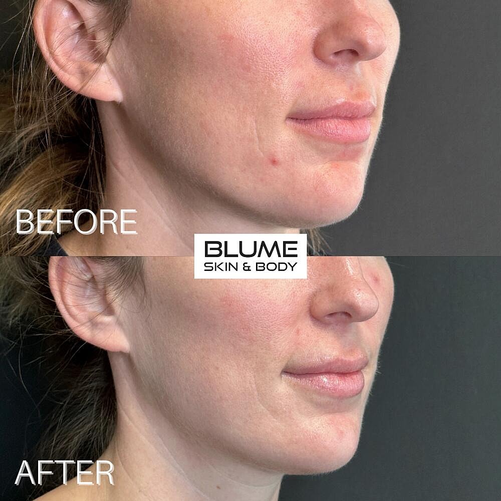 Dermal Fillers Before & After