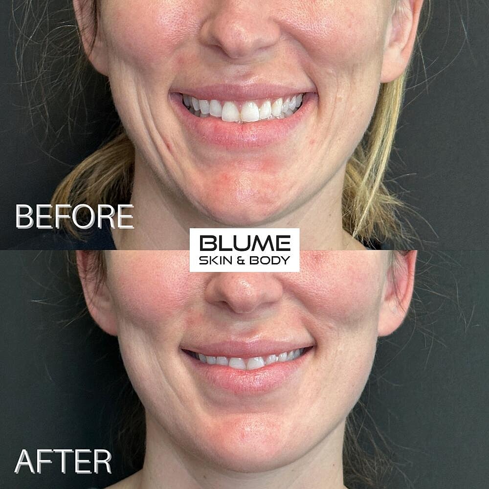 Dermal Fillers Before & After