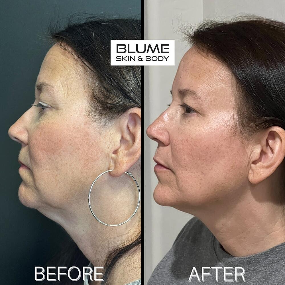 Dermal Fillers Before & After