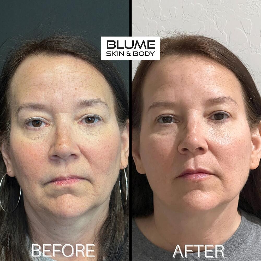 Dermal Fillers Before & After