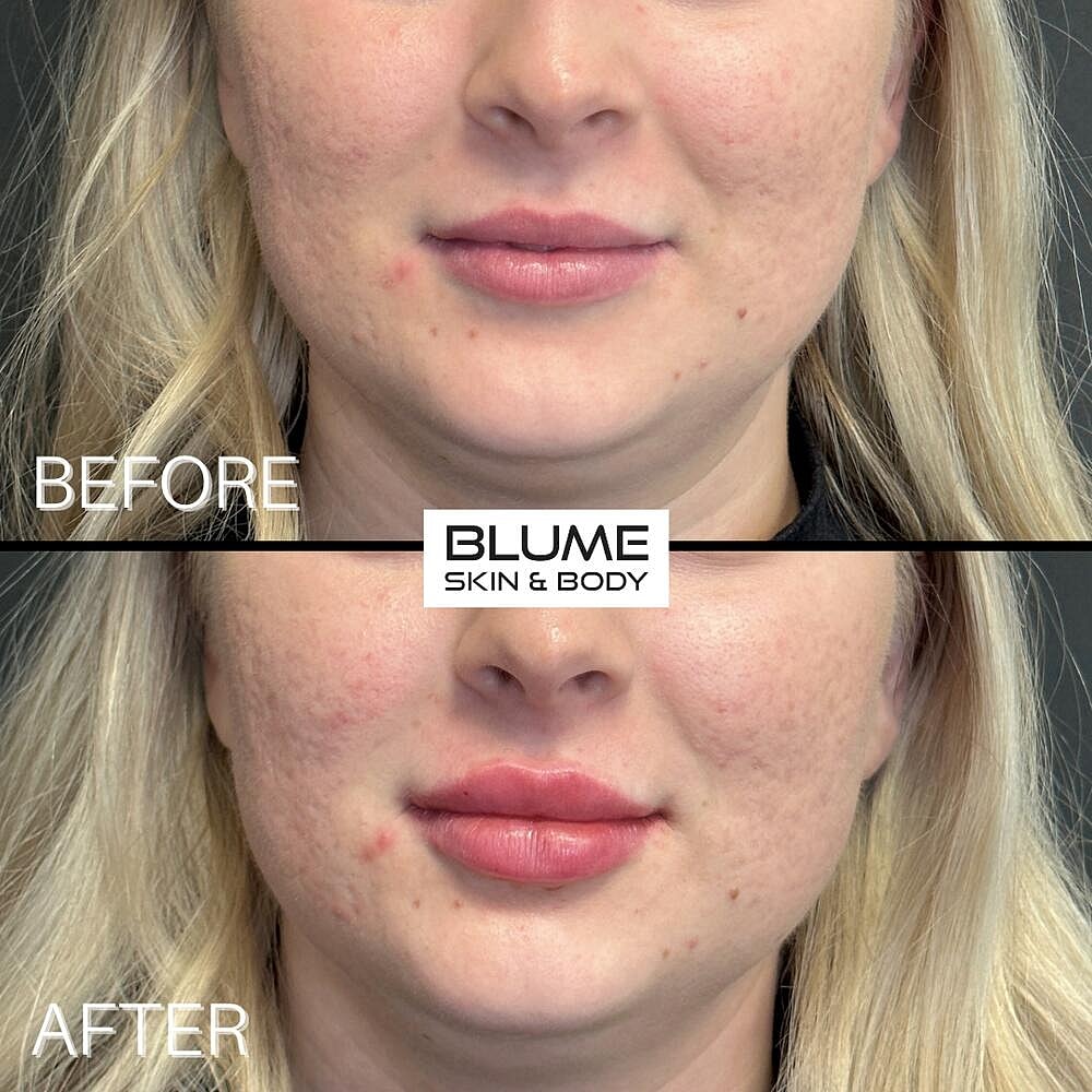 Dermal Fillers Before & After