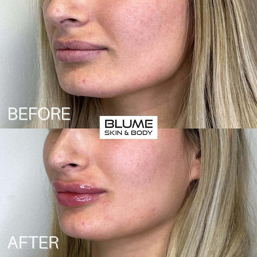 Dermal Fillers Before & After