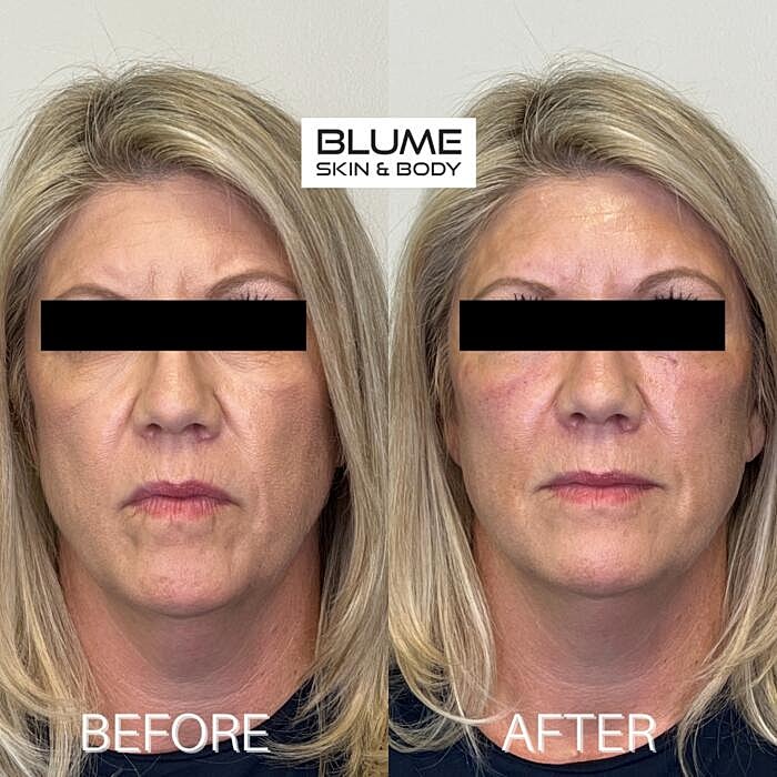 Dermal Fillers Before & After