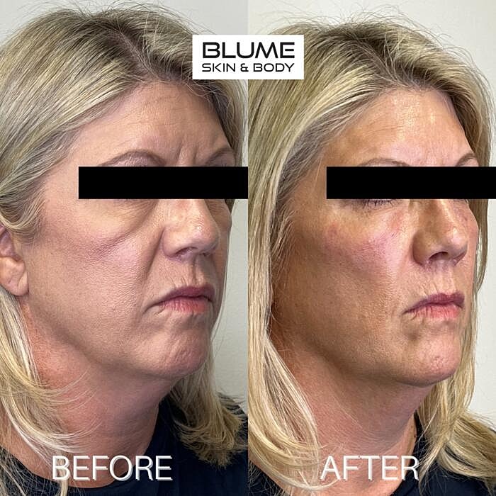Dermal Fillers Before & After