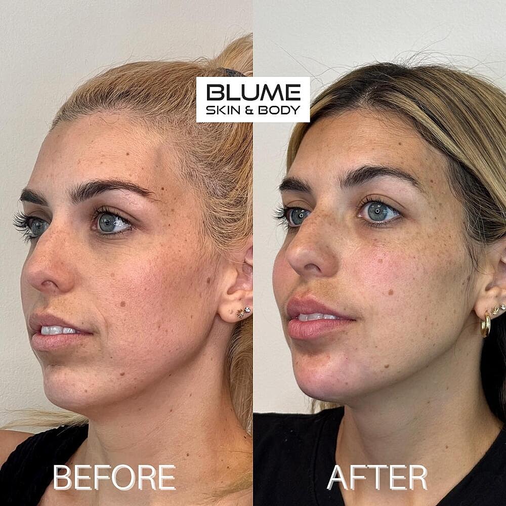 Dermal Fillers Before & After