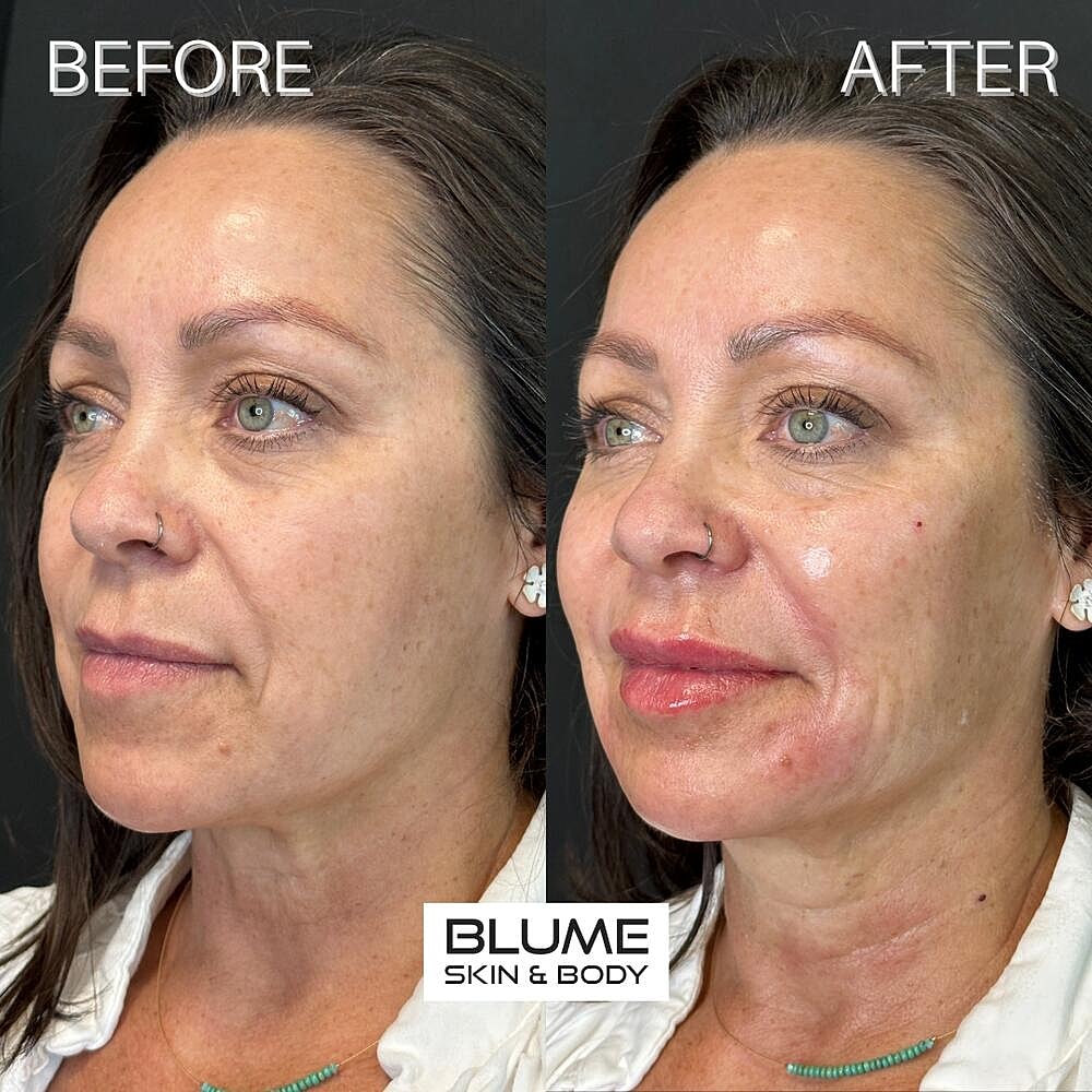 Dermal Fillers Before & After