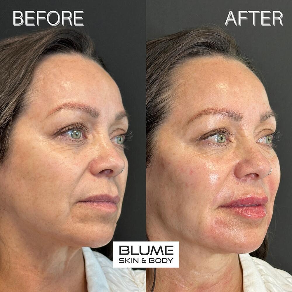 Dermal Fillers Before & After